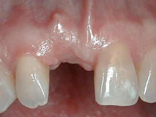 Một vài nguyên nhân gây ra tình trạng mất răng