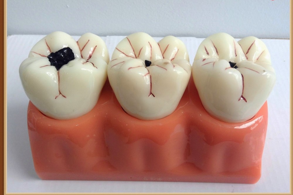 Sâu răng ở trẻ sơ sinh